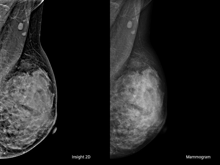 High Definition Breast Tomosynthesis